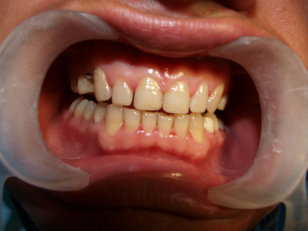 Реставрация фронтальных зубов